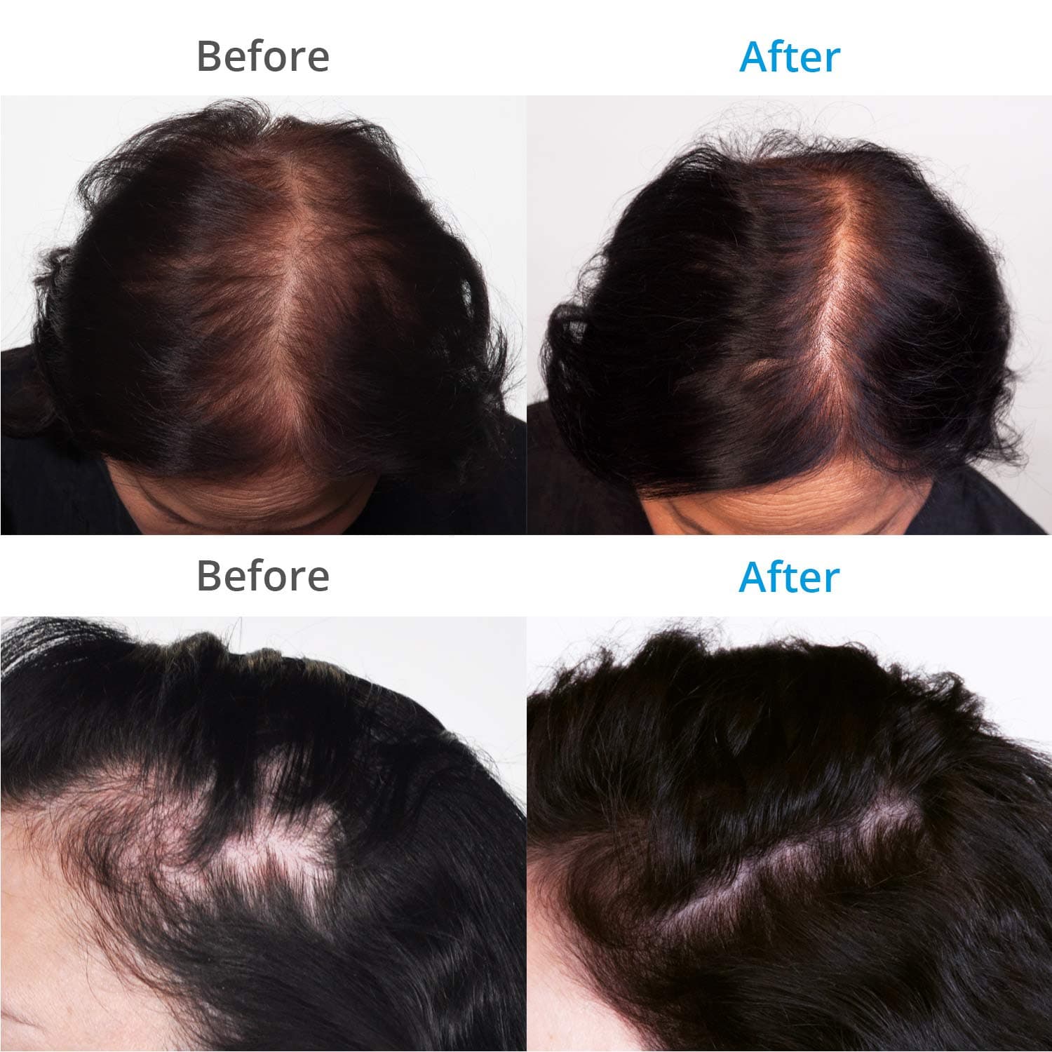 Revolutionize Your Hair Journey: Explore the Visible Transformation! Compare Before and After Images - Experience Fuller, Healthier Hair After Just 30 Days of Regular Use with Our Hair Fall Control Massager. Achieve Results That Speak Volumes. #HairTransformation #VisibleResults #30DaysChallenge